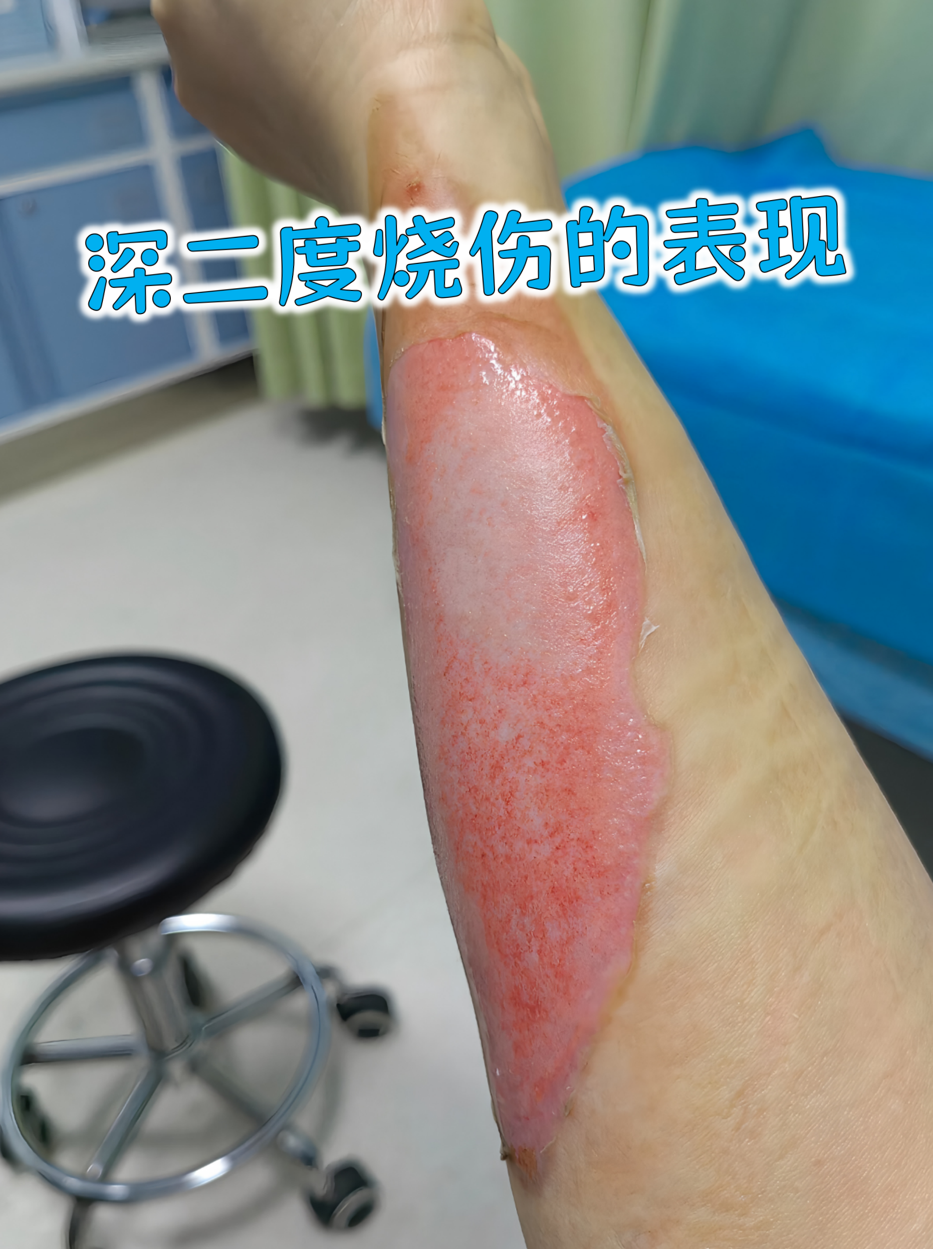 深二度烧伤是皮肤损伤中较严重的类型,它穿透表皮