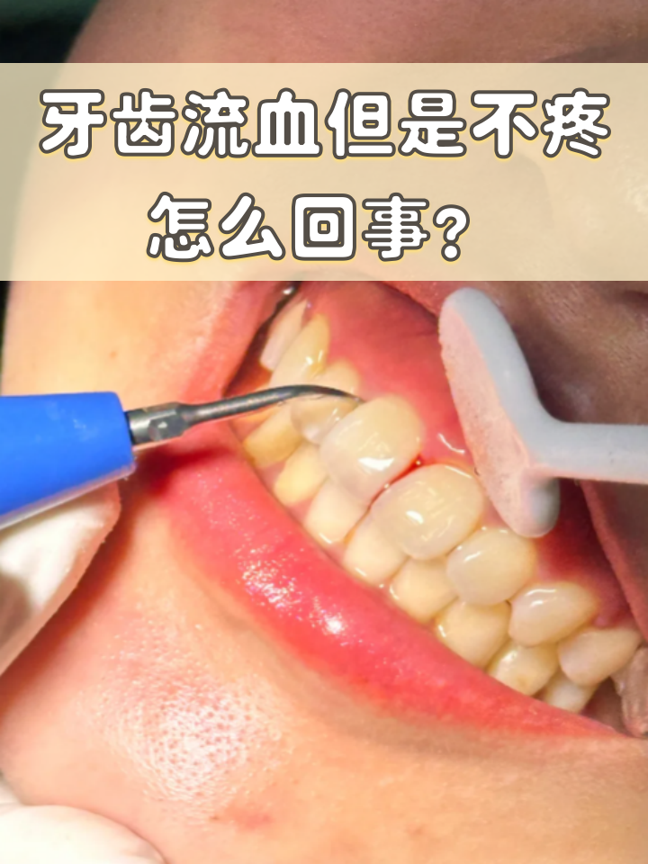 心脏支架吃药后为什么牙齿出血百科在线 心脏支架吃药后为什么牙齿出血百科在线