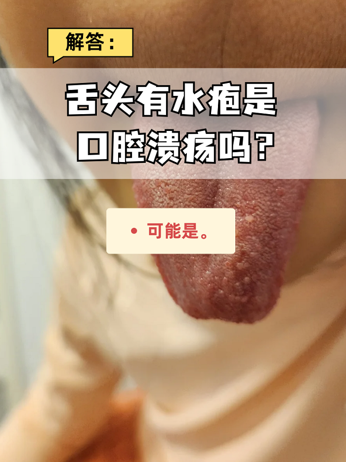 舌头疱疹图片舌头疱疹舌头上长泡是什么原因舌头起泡是怎么回事舌头上