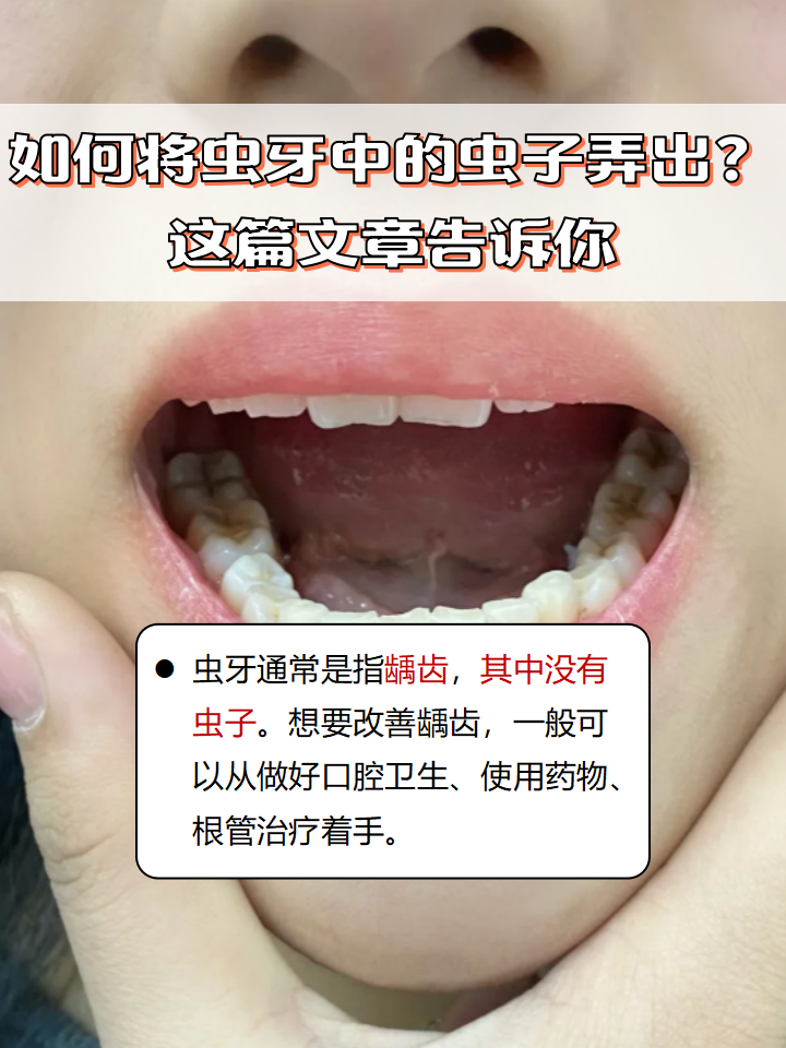 如何将虫牙中的虫子弄出?