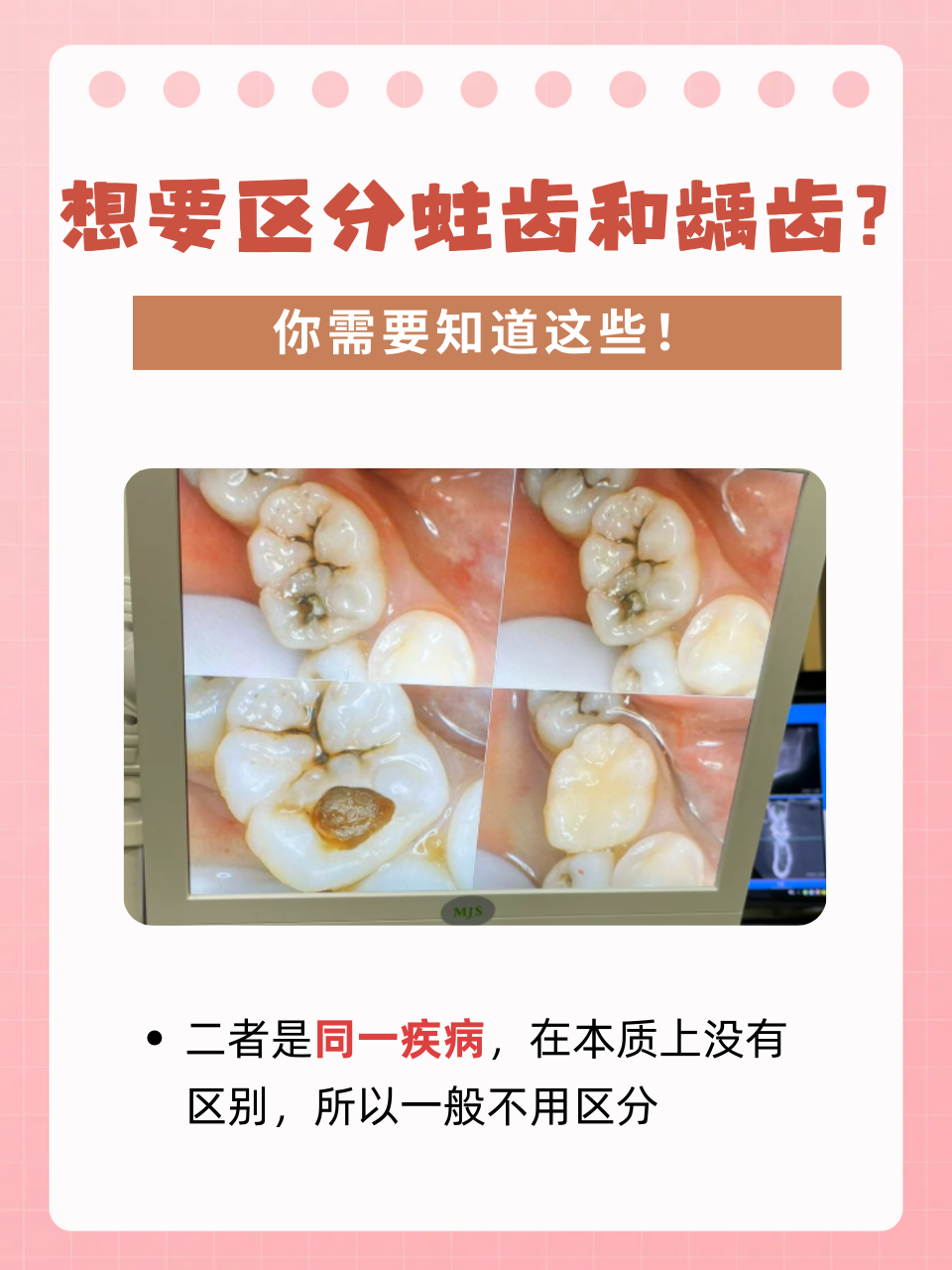 蛀齿在医学上又称为龋齿,所以二者是同一疾病,在本质上没有区别