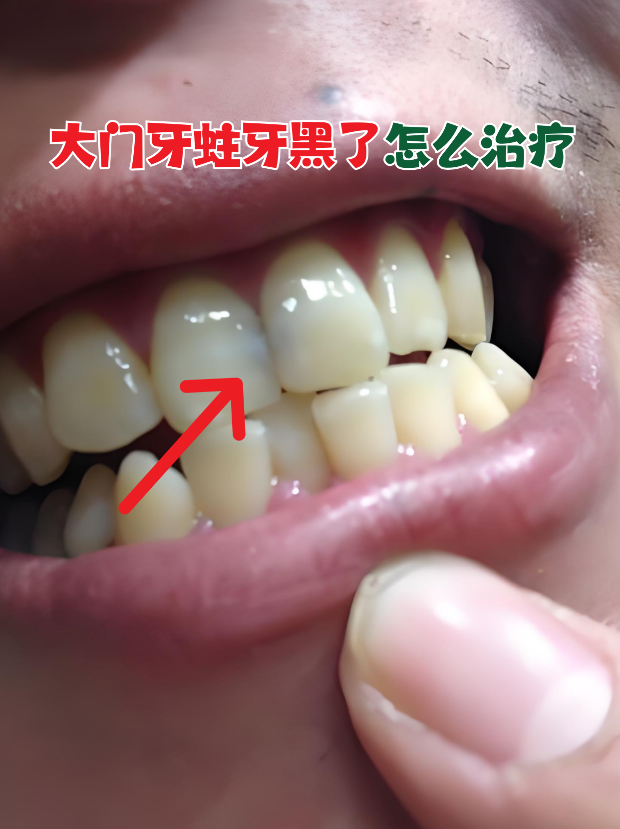 作为牙齿最显眼的"门面担当",及时干预能避免问题恶化