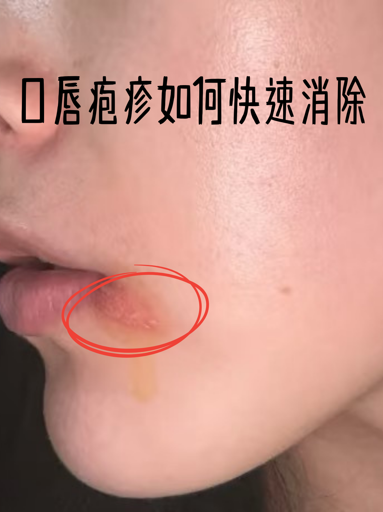 这种由单纯疱疹病毒引起的小水泡,其实掌握正确方法能加速愈合