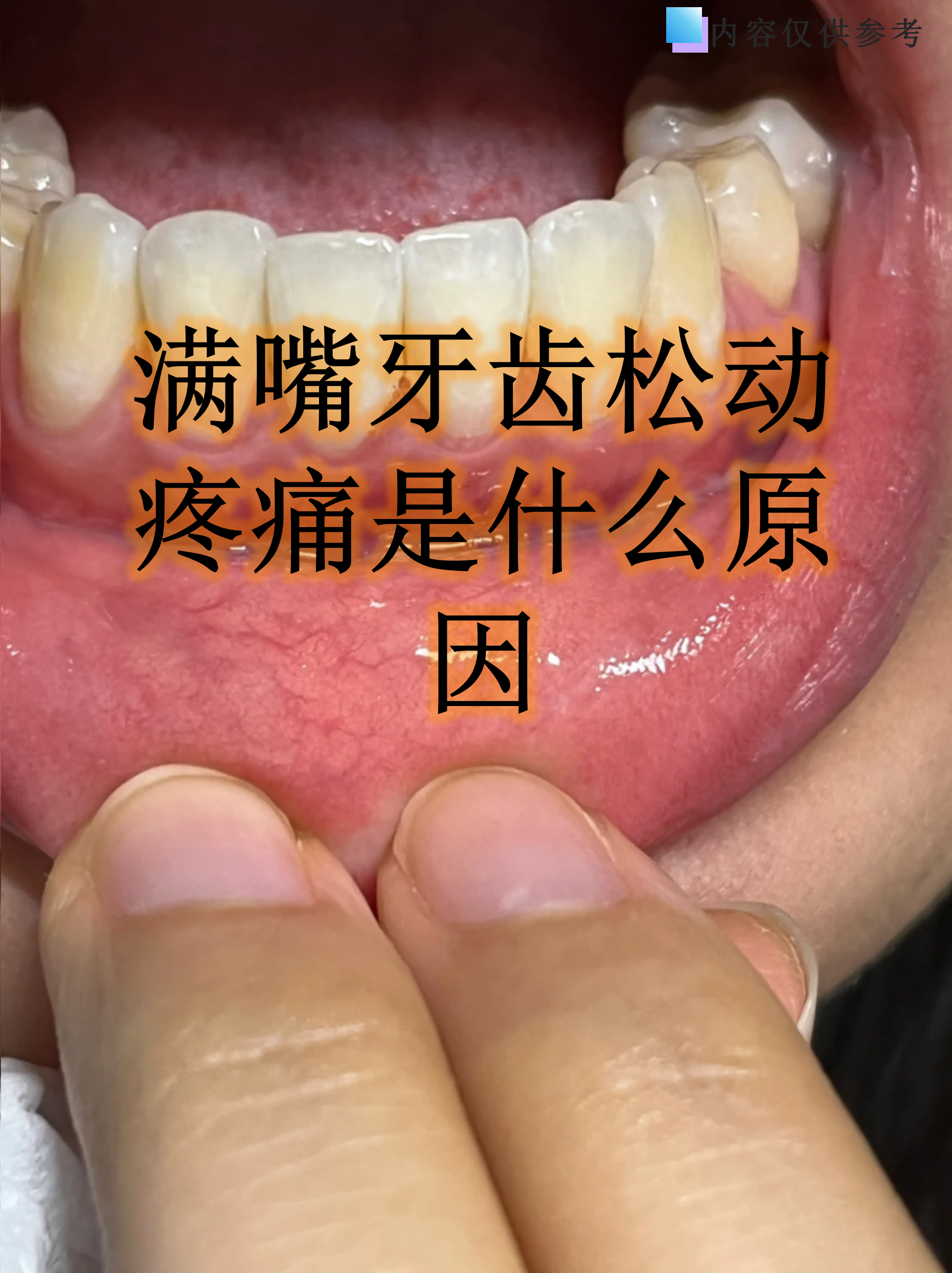 满嘴牙齿松动疼痛是什么原因