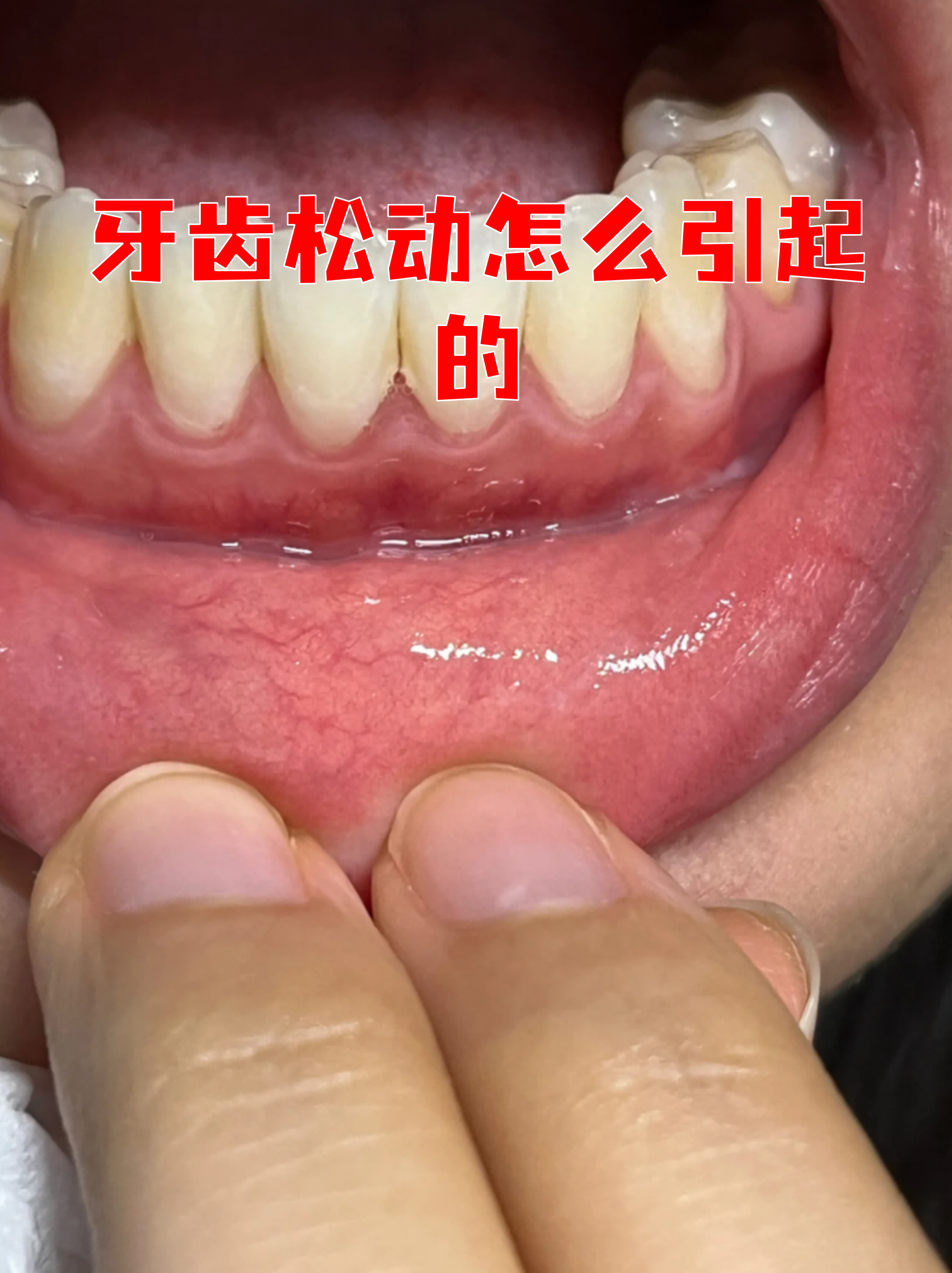 为什么会牙齿松动