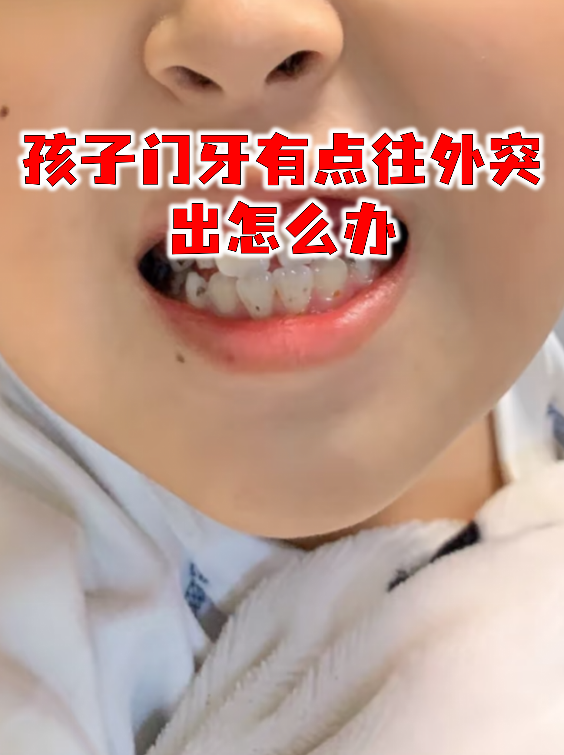 孩子门牙有点往外突出怎么办