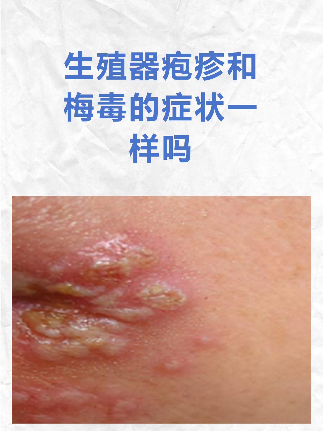 生殖器疱疹和梅毒的症状一样吗