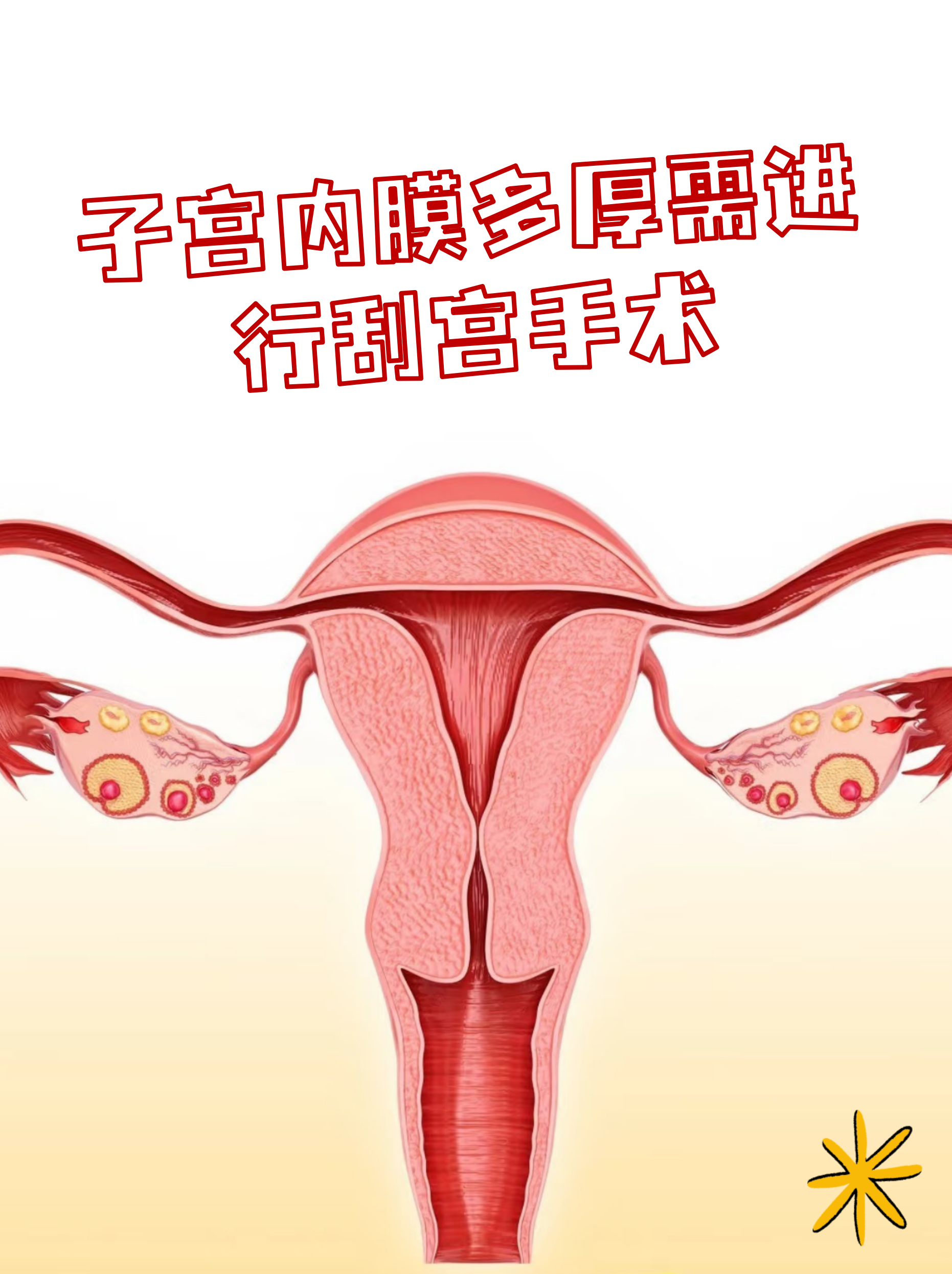 子宫内膜多厚需进行刮宫手术