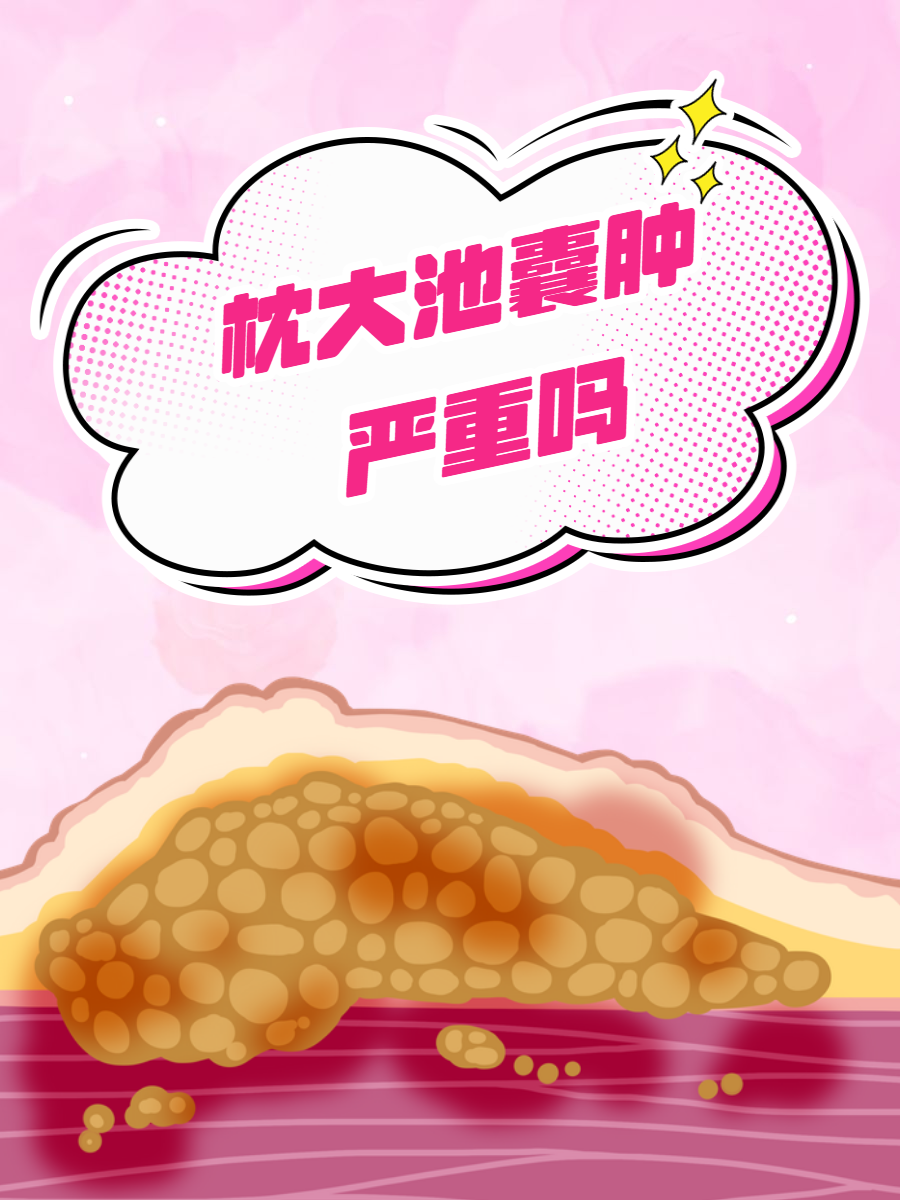 这个名字听起来或许有些让人紧张,枕大池囊肿严重吗?