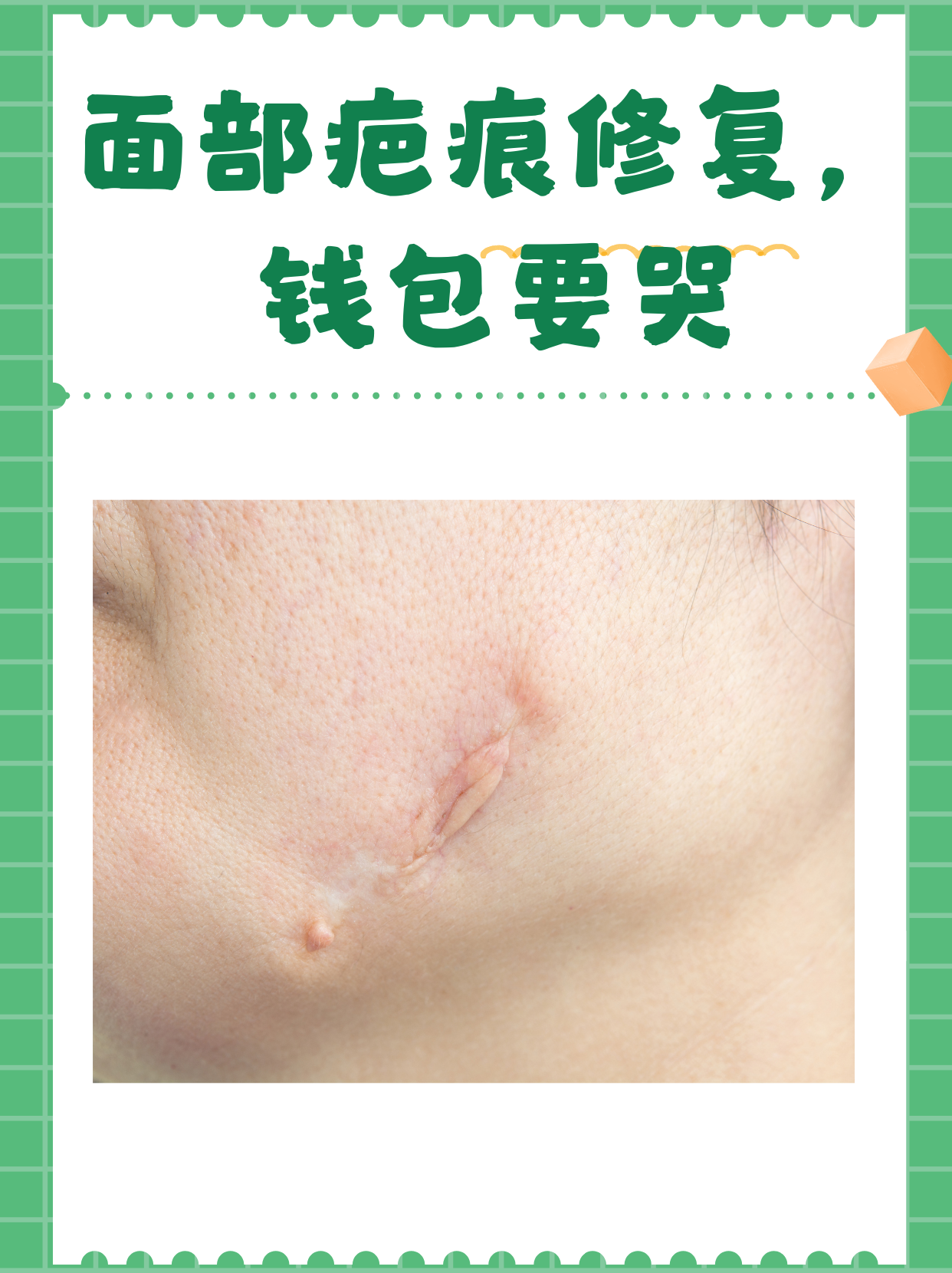 [星星]【治疗方法】 激光治疗:适合色素沉着或轻微凹凸的疤痕,价格