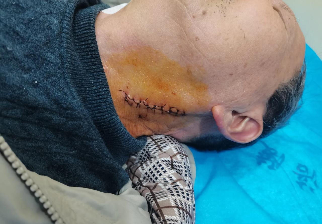 老年痴呆手术术后分享