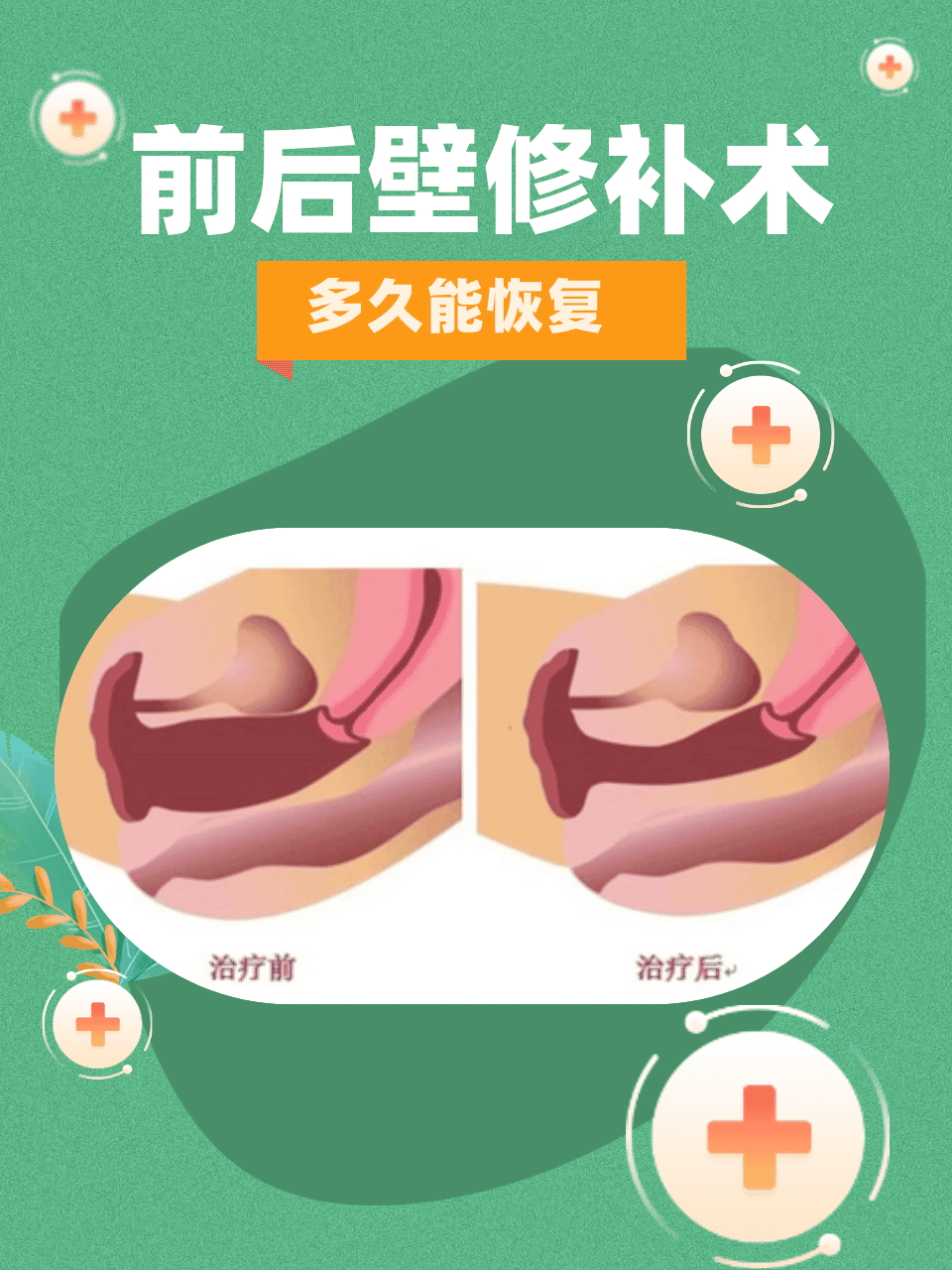 前后壁修补术是一种常见的妇科手术,用于修复子宫前后壁的缺损或撕裂