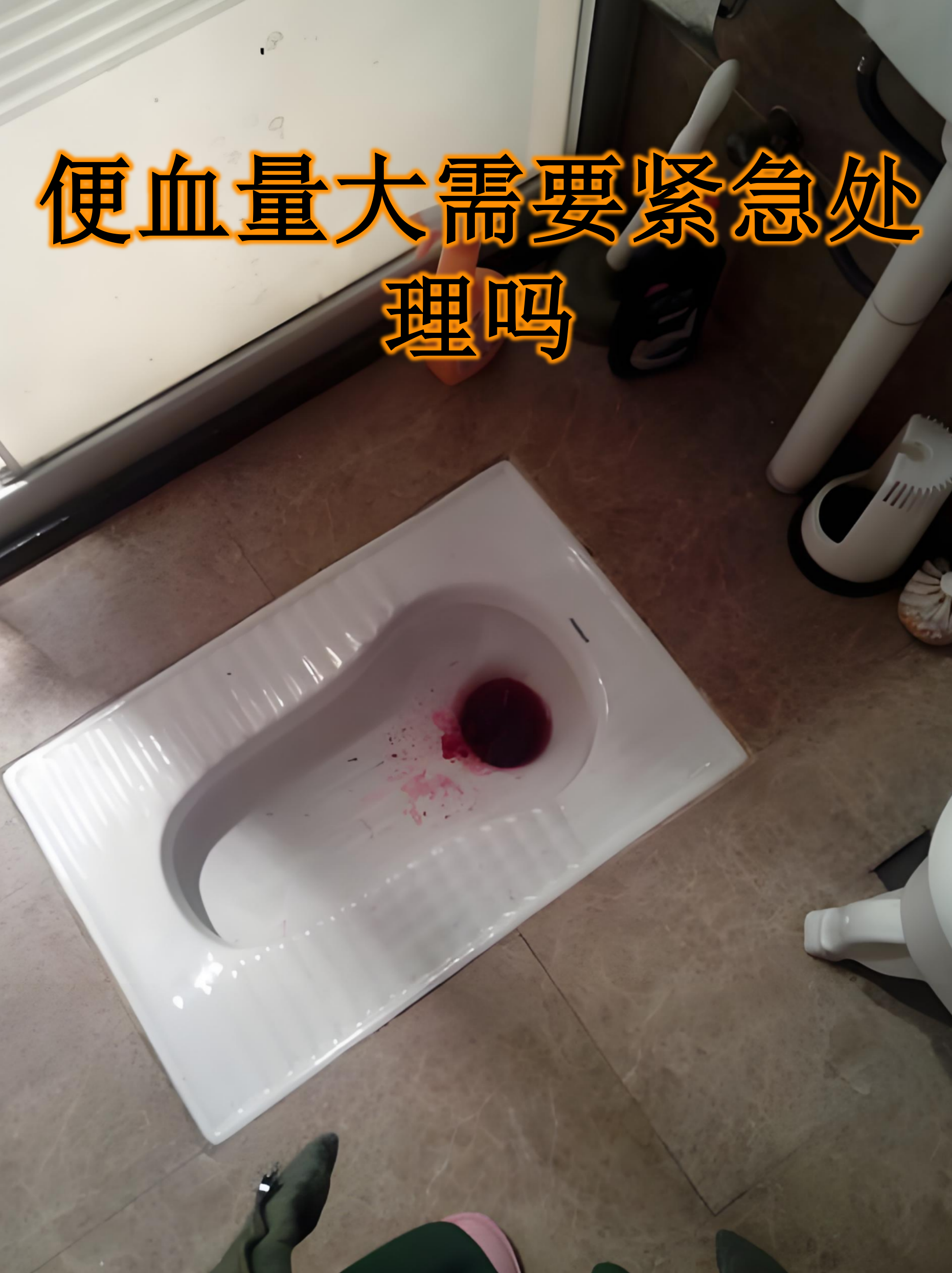 鲜红色血滴或喷射状出血往往来自肛门直肠,而暗红色血块可能涉及更