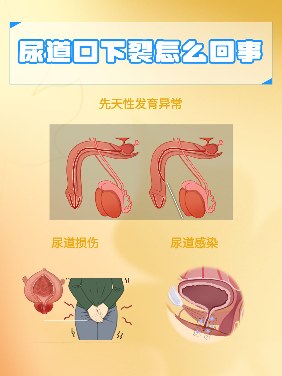 尿道口下裂,又称尿道下裂,是一种常见的先天性尿道畸形