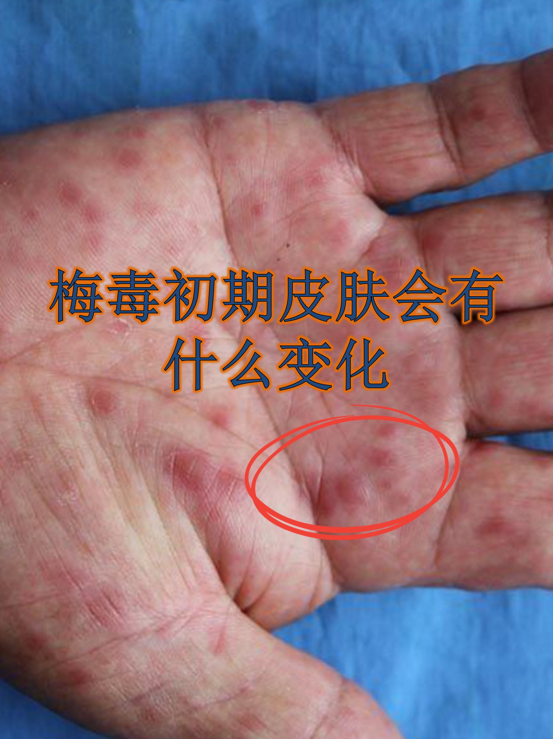 梅毒初期皮肤会有什么变化