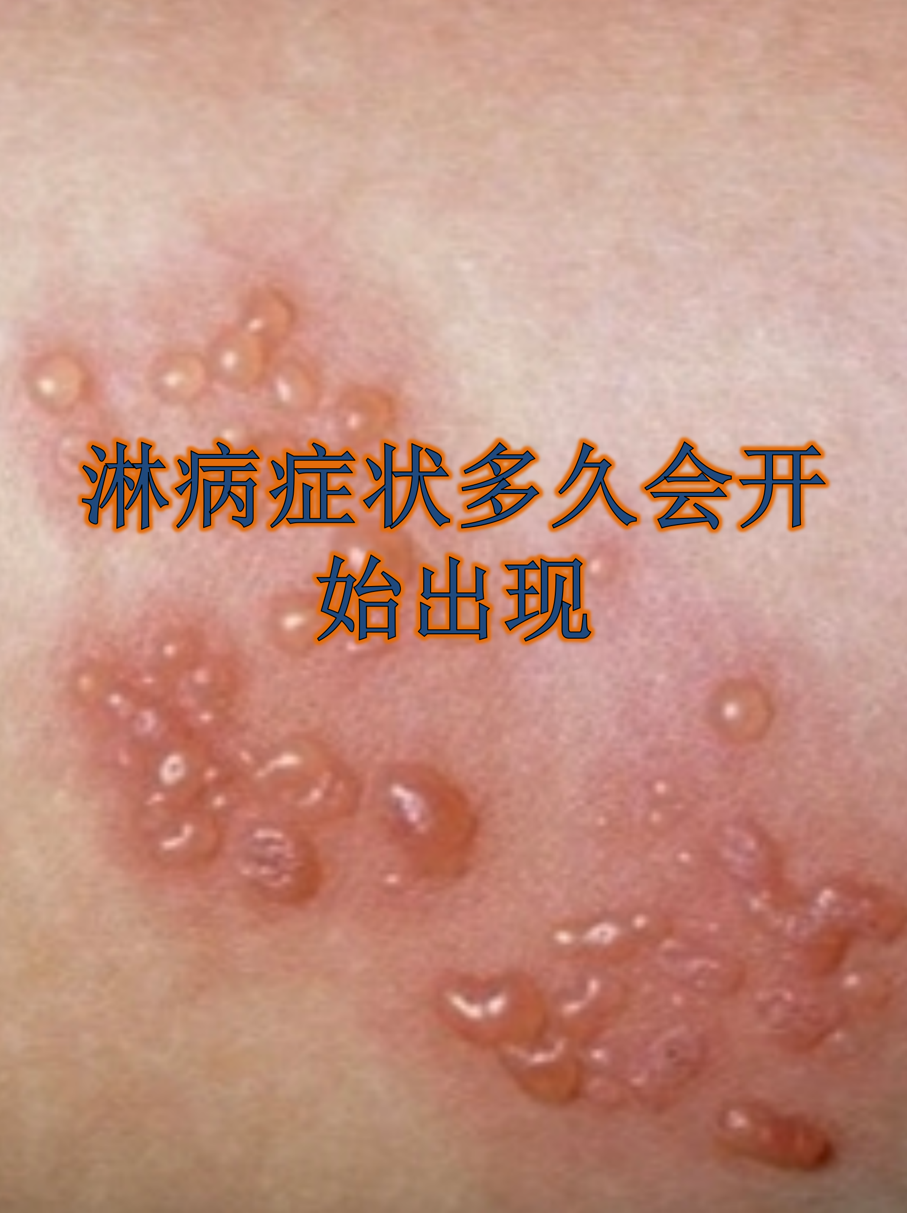  广东流行的传染病(广东最近爆发的传染病)