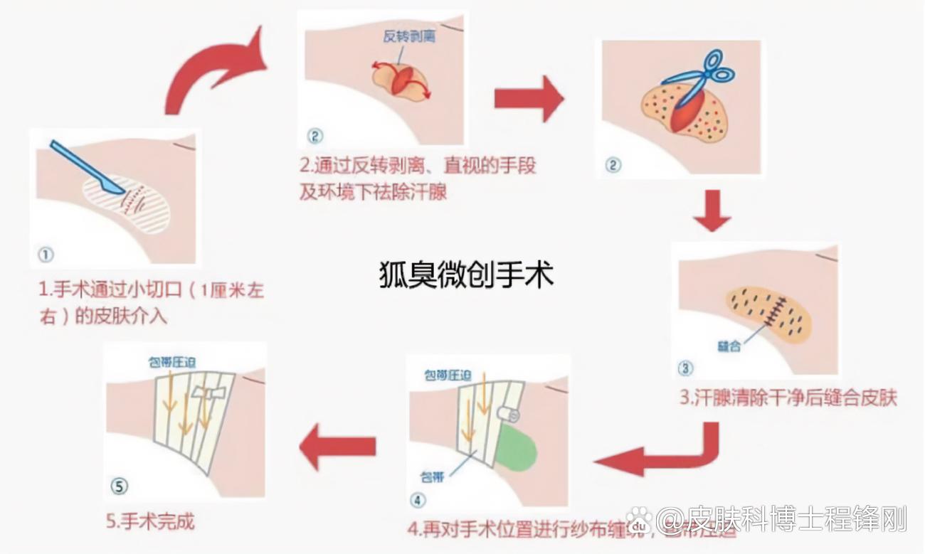 腋臭z字缝合方法图解图片