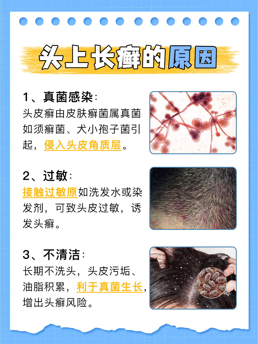 那么,头上长癣是由哪些原因引起的呢?