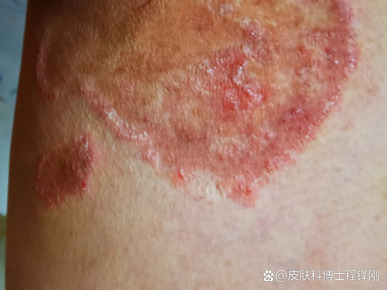 很多人把它当作是湿疹,用了很多激素药膏都不见好
