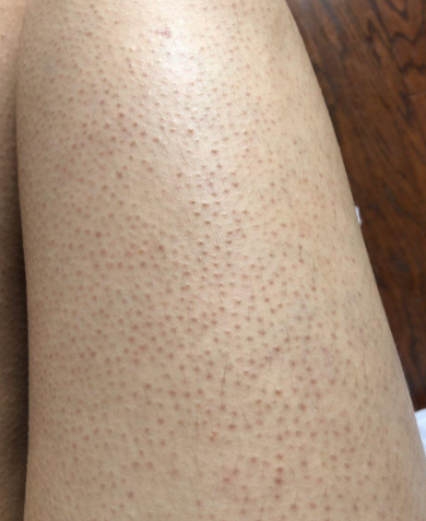 因为她胳膊和大腿上布满了密密麻麻的小颗粒,摸起来粗糙不平,就像鸡皮