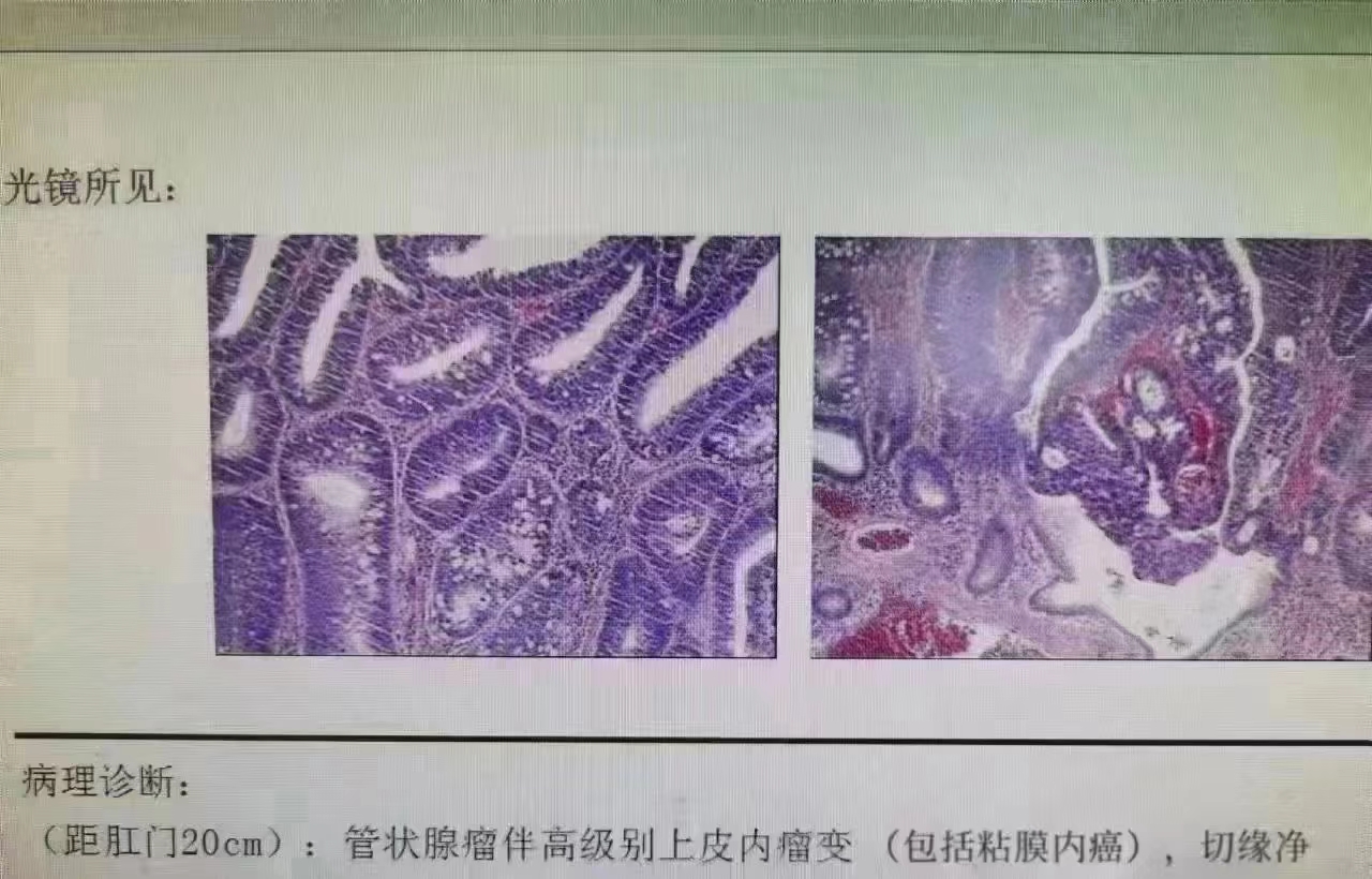 无痛肠镜##肠息肉##长期便血##结肠癌