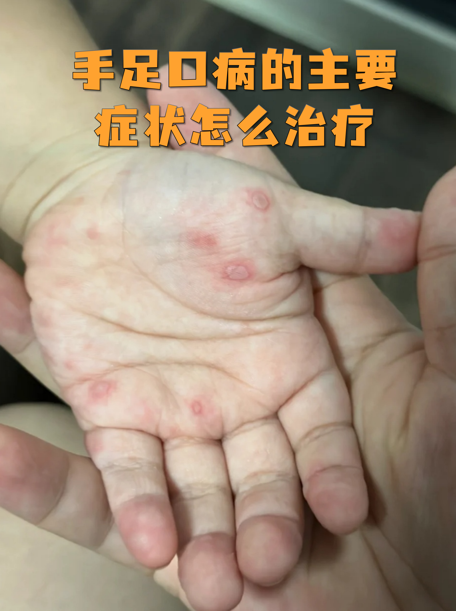  最近病毒感染的症状有哪些图片和症状(最新的病毒感染的症状)