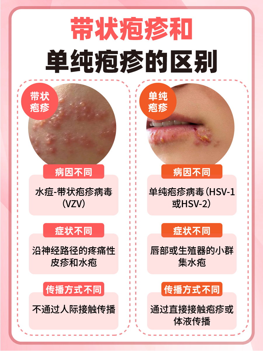 带状疱疹vs单纯疱疹:区别大揭秘!