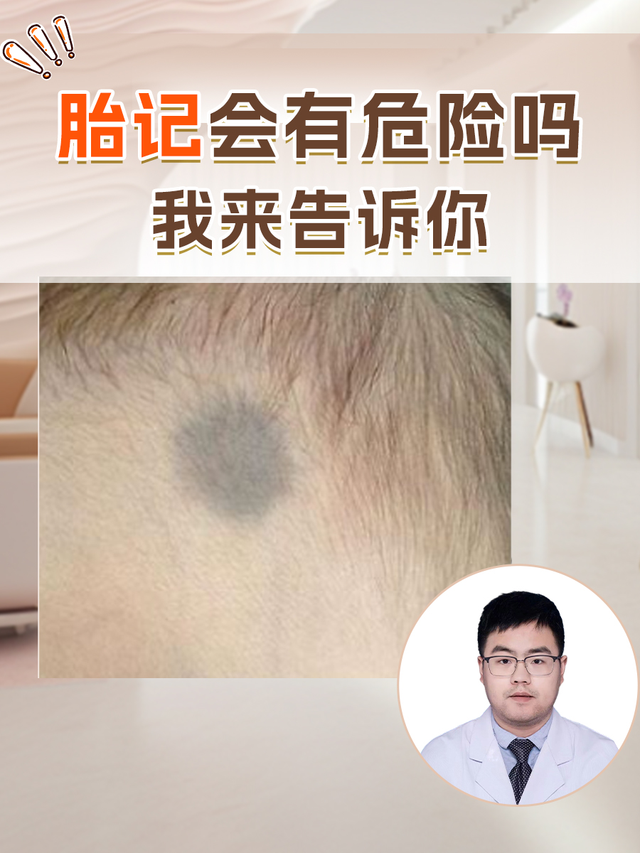 出生后会长胎记吗