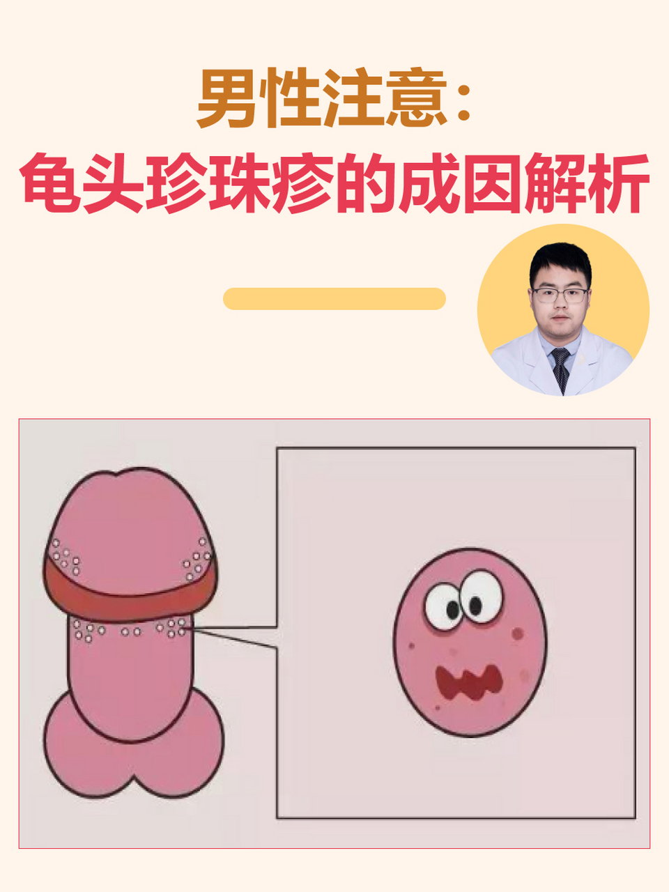 男性注意:龟头珍珠疹的症状解析