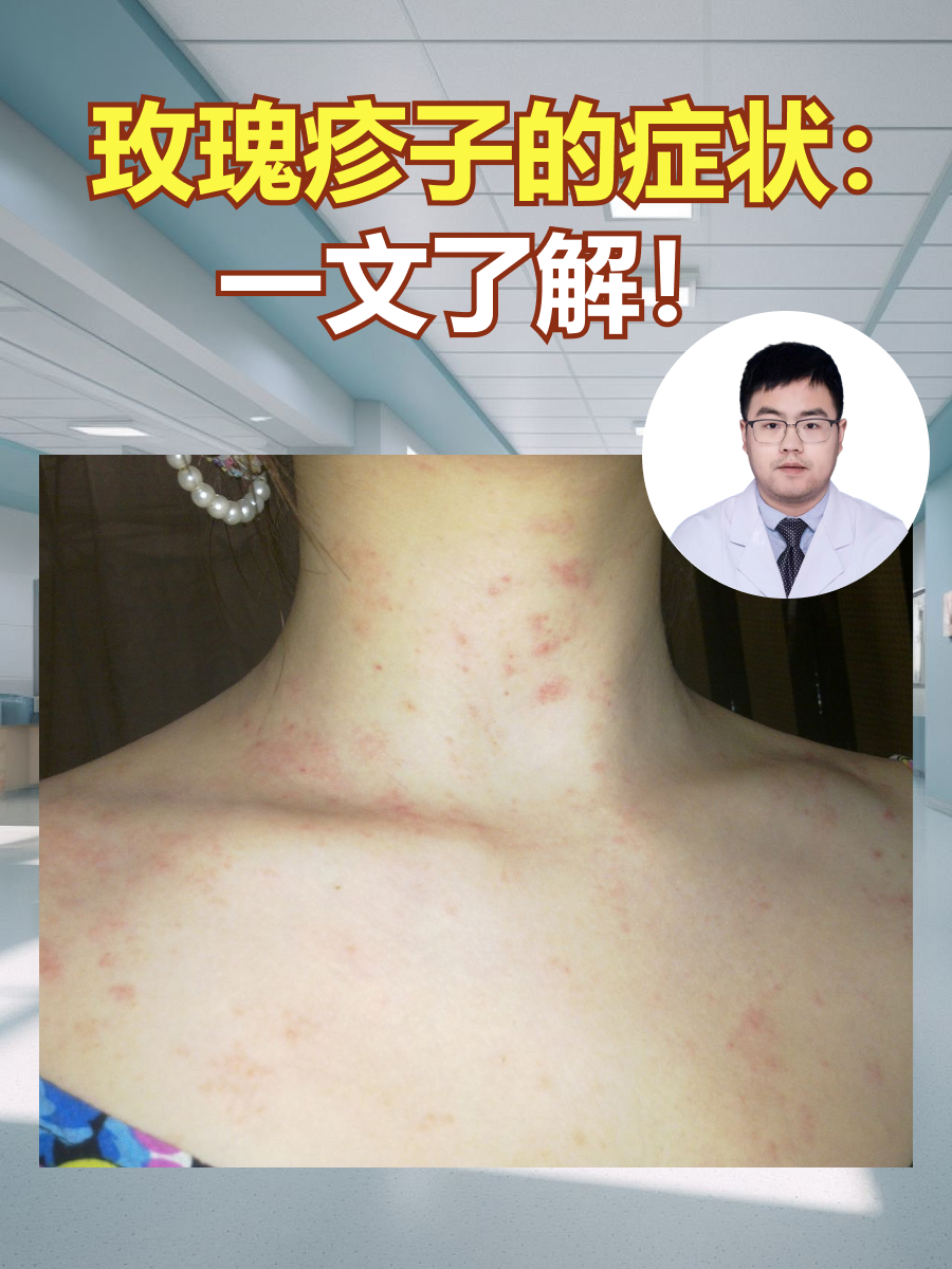 红色斑丘疹:玫瑰疹的主要临床表现是散在