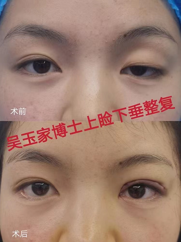 图中的2个小姑娘都是单侧重度上睑下垂,采用提肌缩短,悬吊来做的