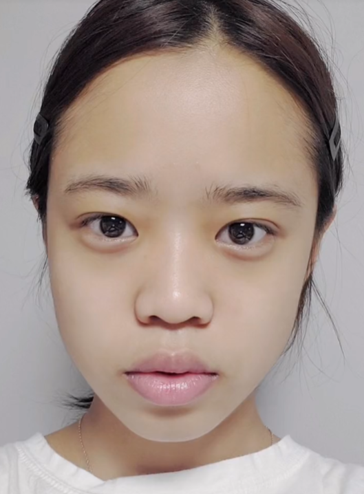 小丫头术前鼻基底凹陷明显,鼻头略大,使得中面部视觉上凹陷明显.