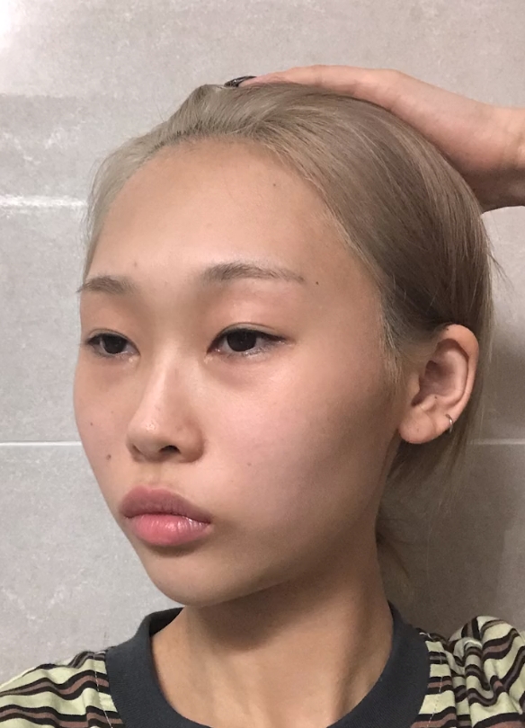 有面诊的求美者问"我从视觉上看嘴凸明显是不是鼻基底凹陷?