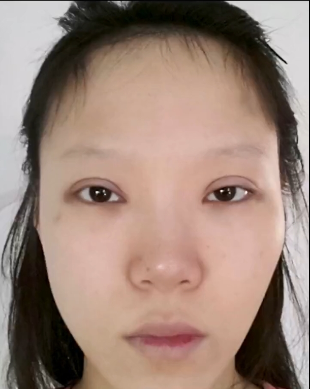 这个双眼皮切的,宽假深,全被这位姑娘占了,切口凹陷且深,双眼皮又大又