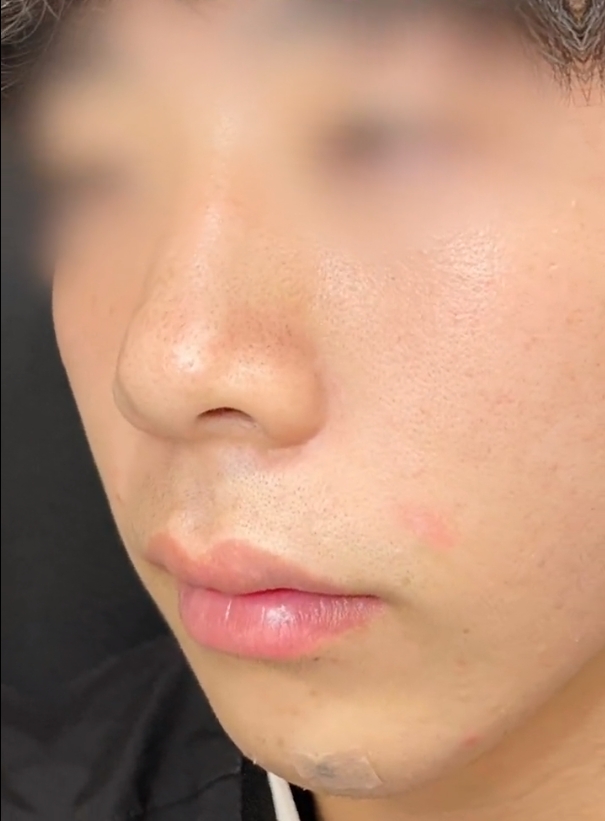 做完鼻基底年龄大了会不会凸起呢?