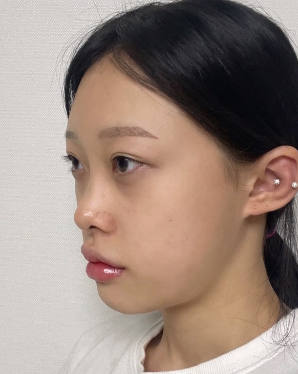 鼻基底的高度,主要是指鼻翼下方底部与鼻小柱相同方向上(即前后方向上