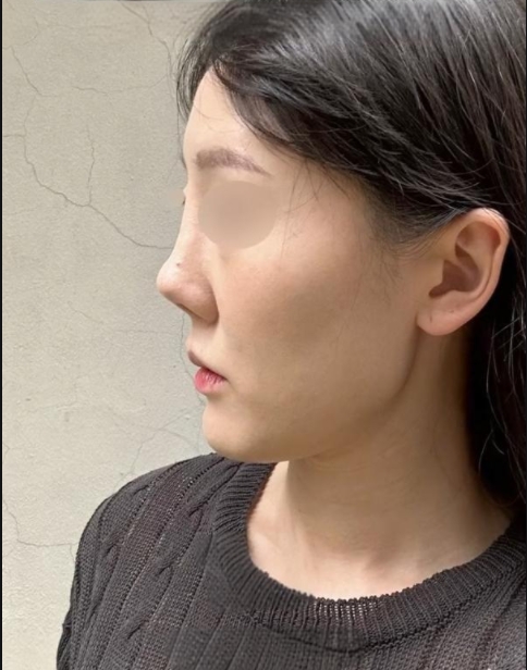 鼻尖夹捏畸形宝宝小时候什么样的鼻子长大后好看术后鼻头在变低,支架