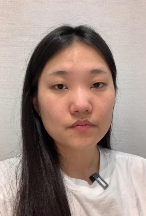 鼻背宽,鼻子低矮,鼻翼宽大,整形后2个月,都说太美了!