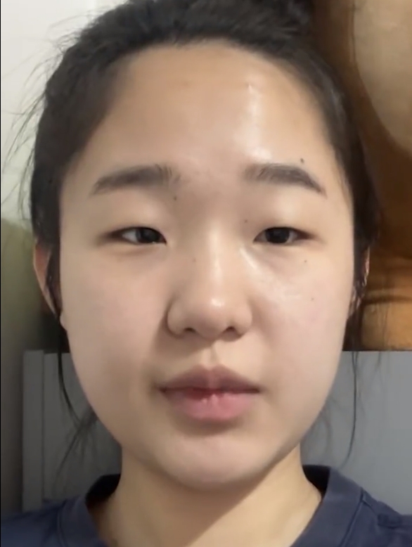 姑娘是典型的短鼻,鼻头比较钝,鼻头比较肉,鼻尖突出度不够,没有敝现