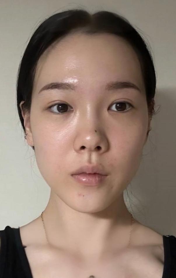 姑娘是典型的,蒜头鼻,鼻头大,鼻翼肥大外扩,没有山根,整个鼻子在