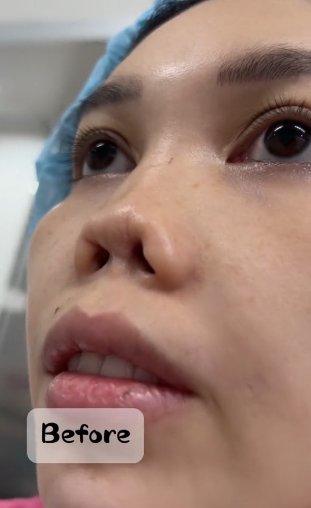 28岁广东女子5次鼻整形失败,亲戚朋友劝不住,6个月后看到效果傻眼了!