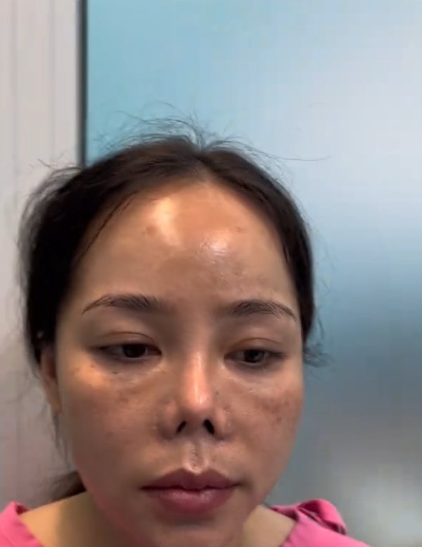 隆鼻手术失败导致鼻子挛缩,鼻体明显缩短,使得整个鼻子看起来十分怪异