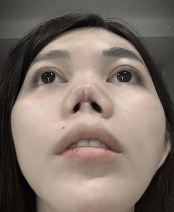 32岁南方姑娘毅然踏上整形路,术前放话:我绝不后悔!