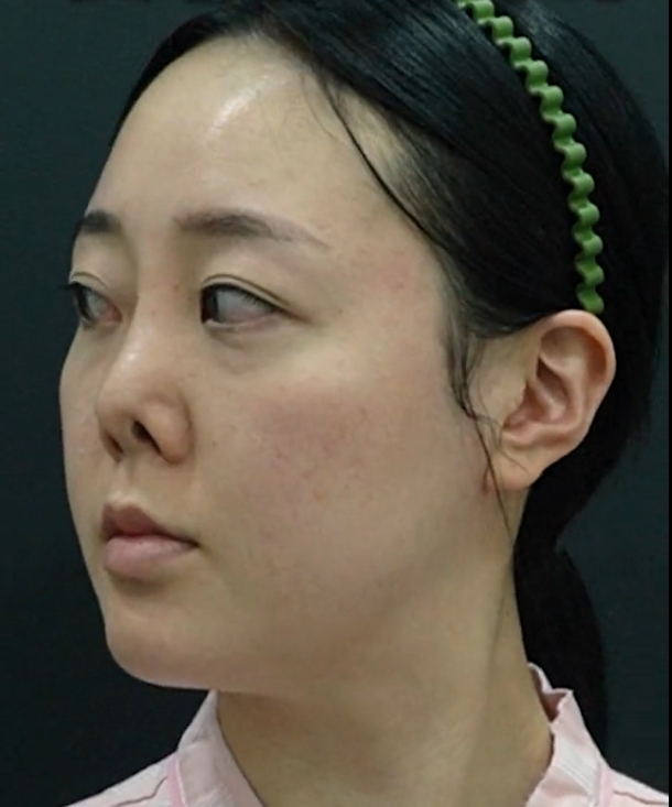 语  以下内容来自求美者自述整理: 大学毕业那年,我跟风做了隆鼻手术