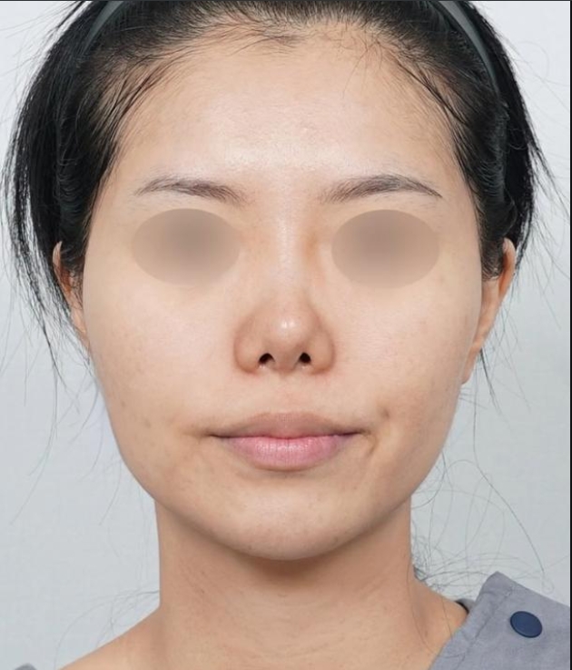 姑娘之前做植入的假体,有中度的挛缩,鼻头后缩,鼻唇角过大,鼻额角转折