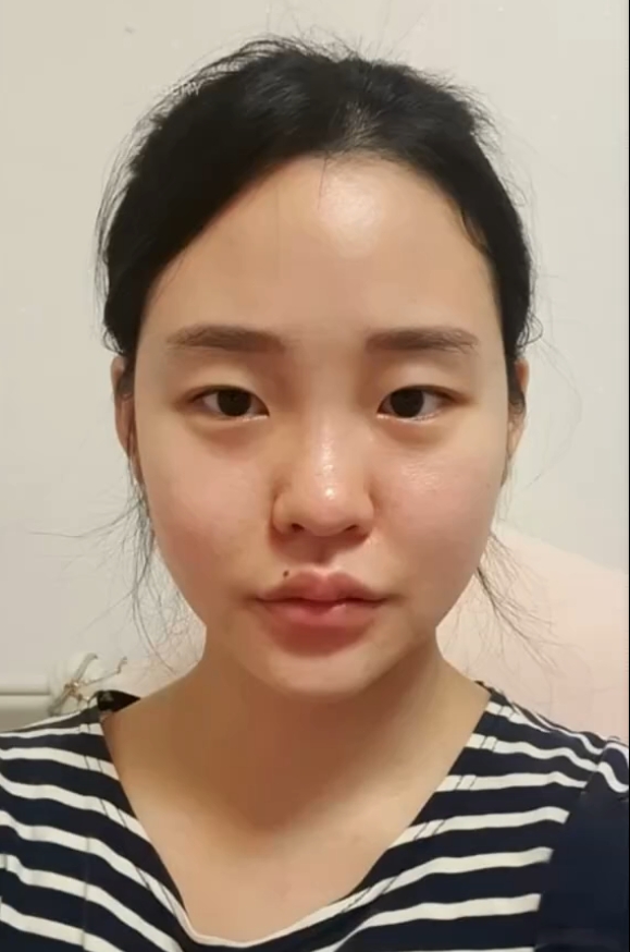 鼻子低平,矮塌,鼻翼两侧肥厚,外扩明显,鼻头圆钝,没有表现点,海鸥线