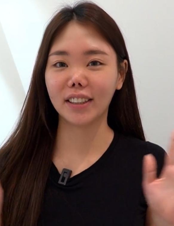 后,姑娘鼻尖呈向上走的趋势并且挛缩明显,鼻背短塌,鼻翼有明显的疤痕