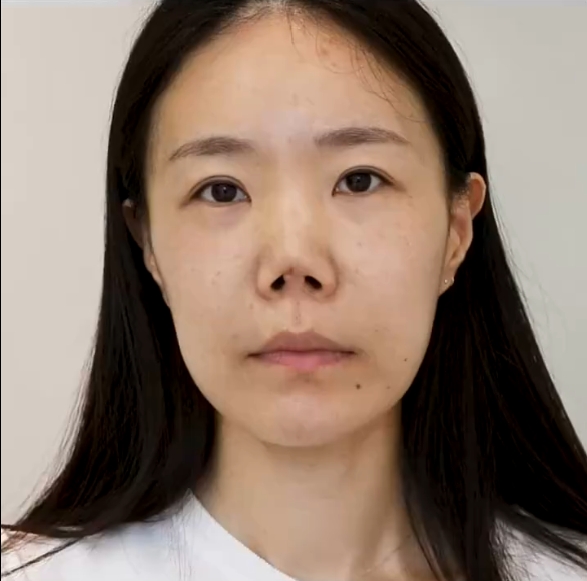 感染挛缩鼻修复,术后3个月判若两人!