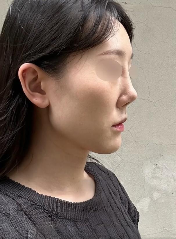 姑娘因鼻梁假体挛缩,不仅导致鼻梁低平,还伴随鼻翼宽大;加之鼻头曾