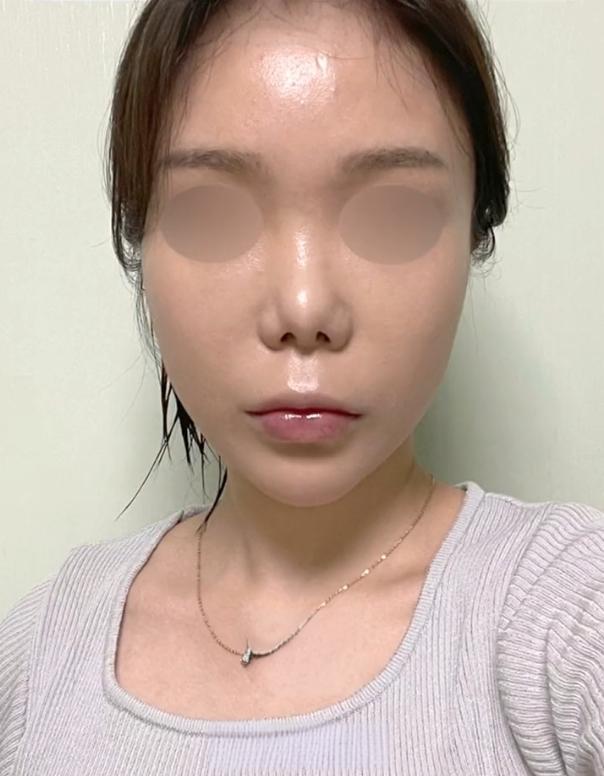 鼻挛缩,假体显形找上门!修复需兼顾颜值与功能!